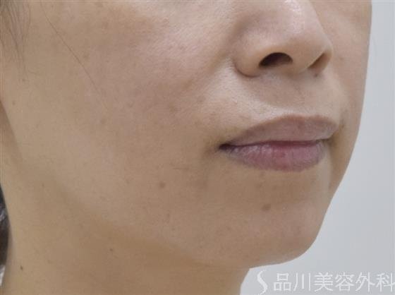 症例NO.50468のBEFORE写真
