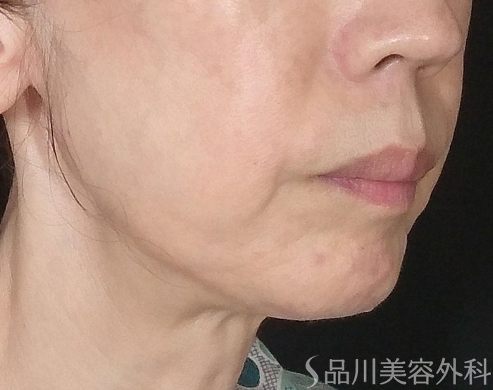 症例NO.65259のBEFORE写真