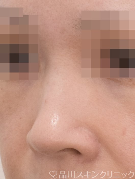 症例NO.71680のBEFORE写真
