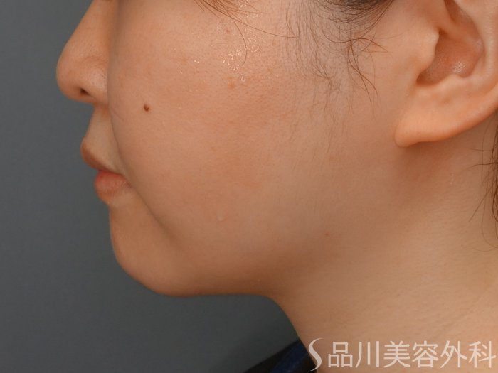 症例NO.73754のAFTER写真