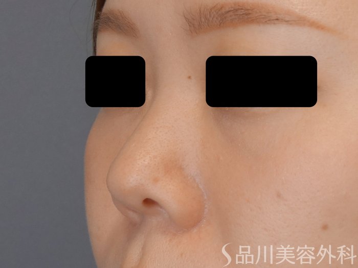 症例NO.70400のBEFORE写真