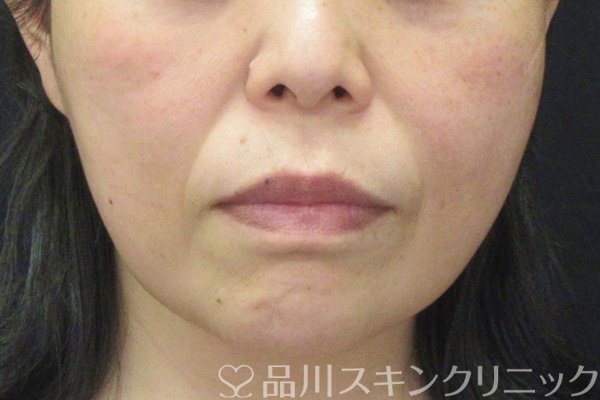 症例NO.64776のBEFORE写真
