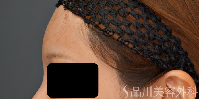 症例NO.73259のBEFORE写真