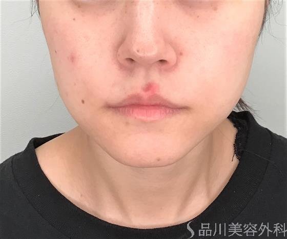 症例NO.57016のBEFORE写真