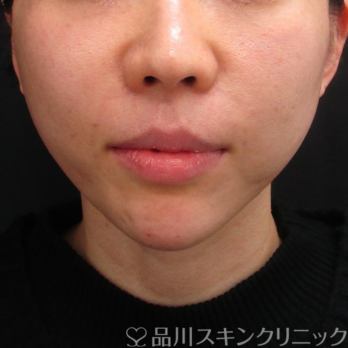 症例NO.70281のAFTER写真