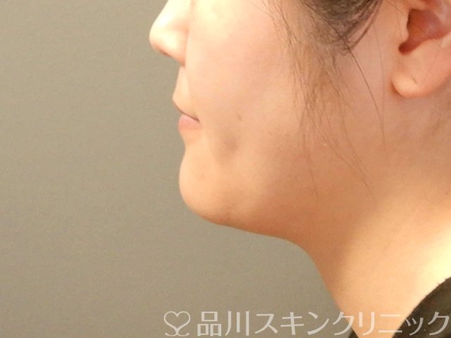 症例NO.65671のBEFORE写真