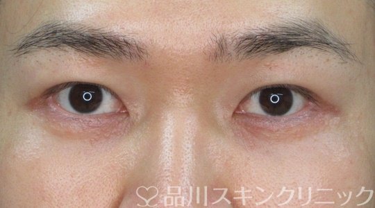 症例NO.71790のAFTER写真
