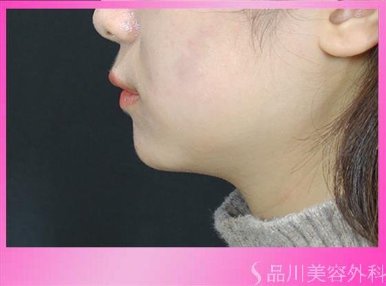 症例NO.50198のBEFORE写真