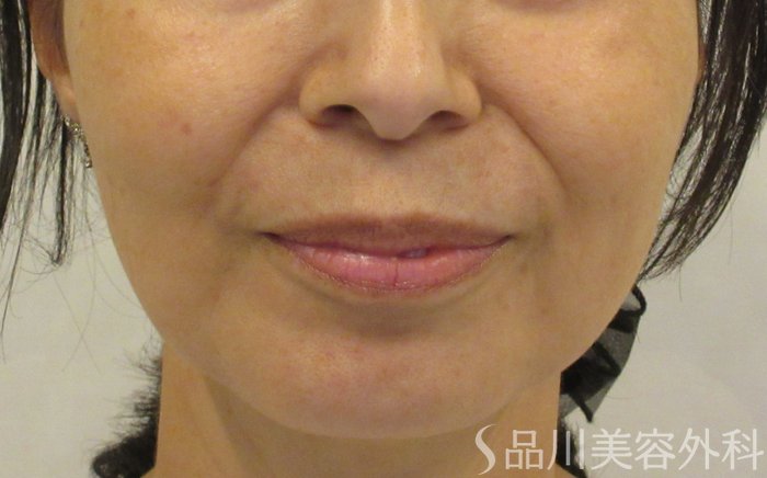 症例NO.71550のBEFORE写真