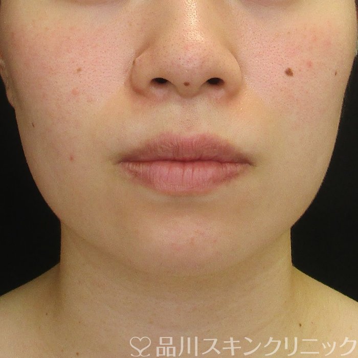 症例NO.73354のBEFORE写真