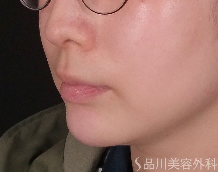 症例NO.69476のAFTER写真