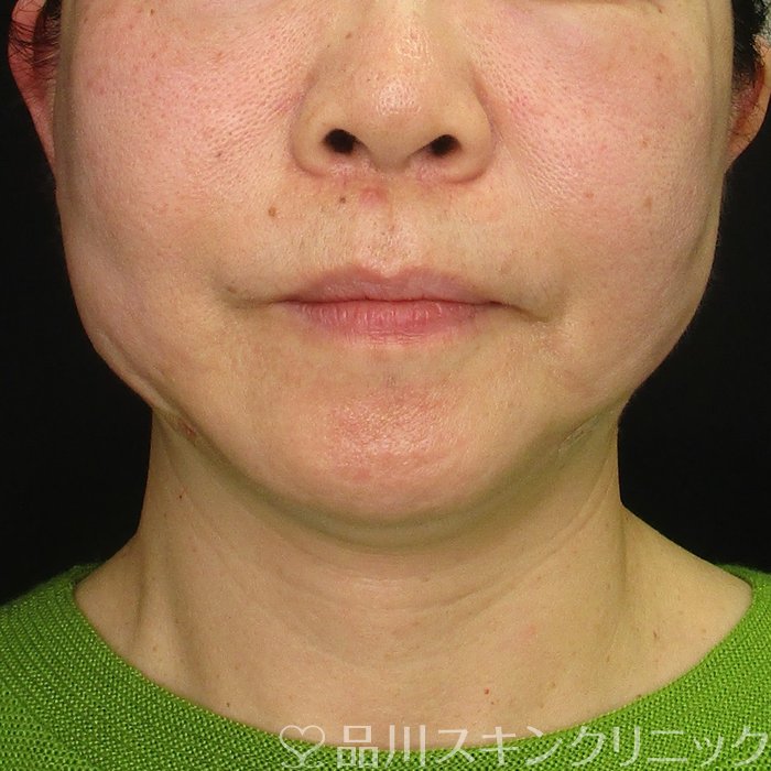 症例NO.68634のAFTER写真