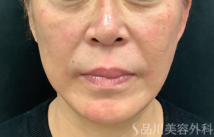 症例NO.71317のAFTER写真