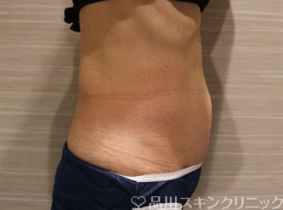 症例NO.41706のBEFORE写真