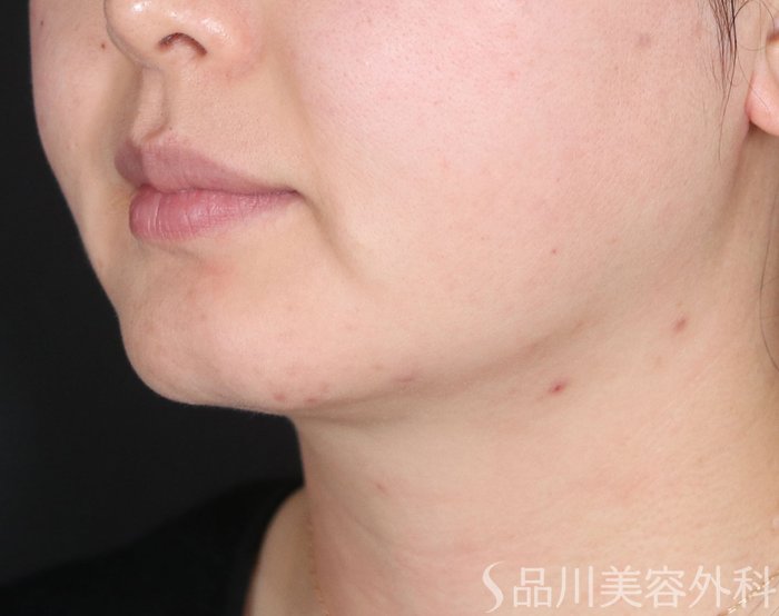 症例NO.72635のBEFORE写真