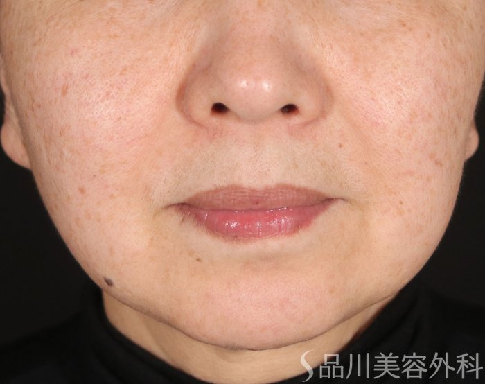 症例NO.73359のBEFORE写真