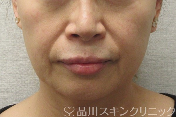 症例NO.72768のBEFORE写真