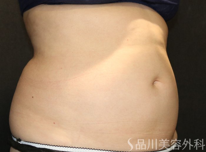 症例NO.73046のAFTER写真
