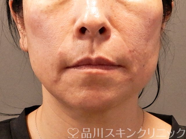 症例NO.70858のAFTER写真