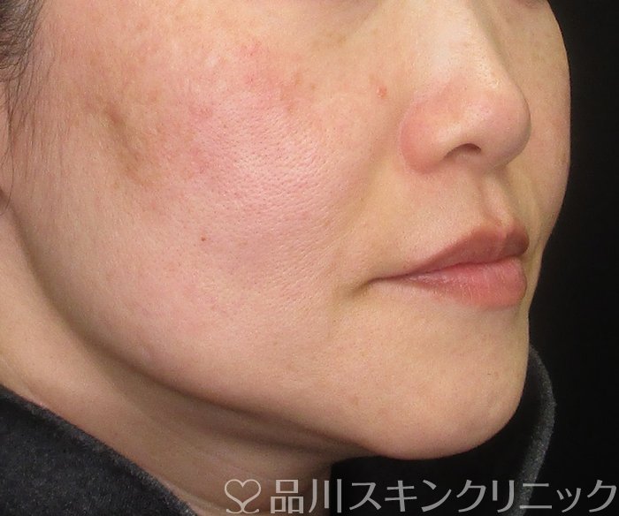 症例NO.75071のBEFORE写真