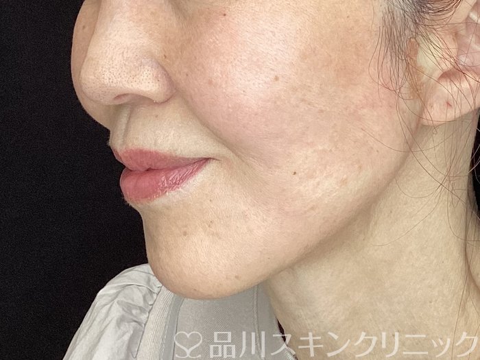 症例NO.72497のAFTER写真