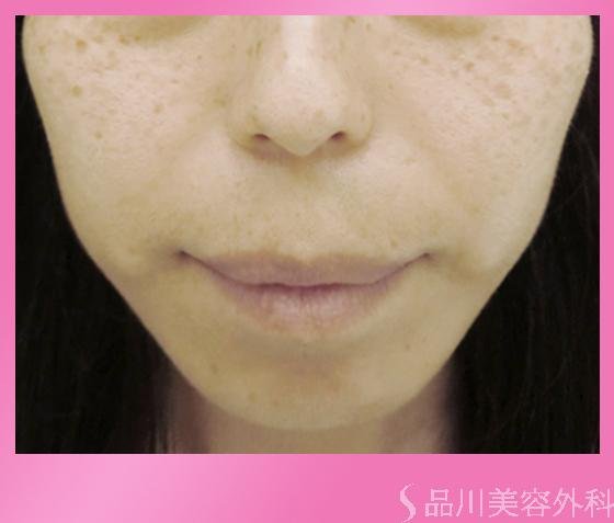 症例NO.317のBEFORE写真