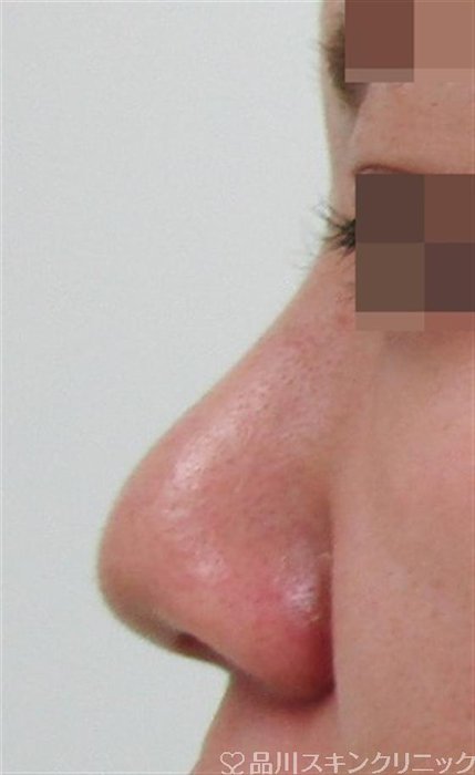 症例NO.32660のBEFORE写真