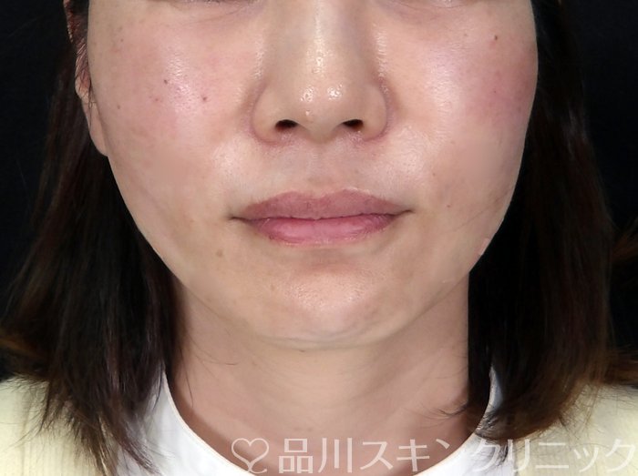 症例NO.72560のAFTER写真