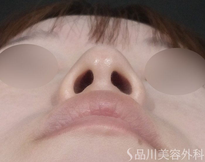 症例NO.71709のAFTER写真