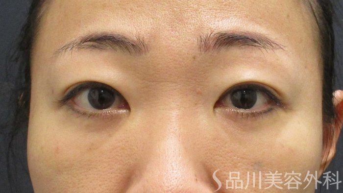 症例NO.65441のAFTER写真