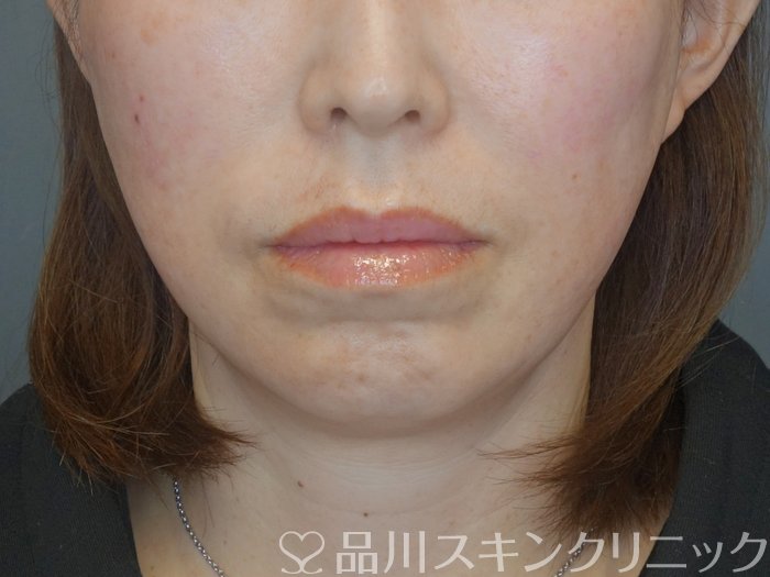 症例NO.72596のAFTER写真