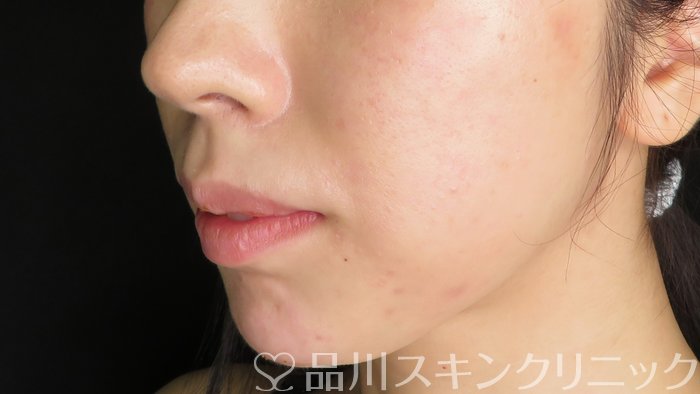 症例NO.71286のAFTER写真