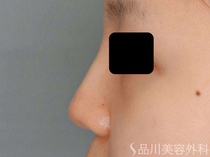 症例NO.70911のAFTER写真