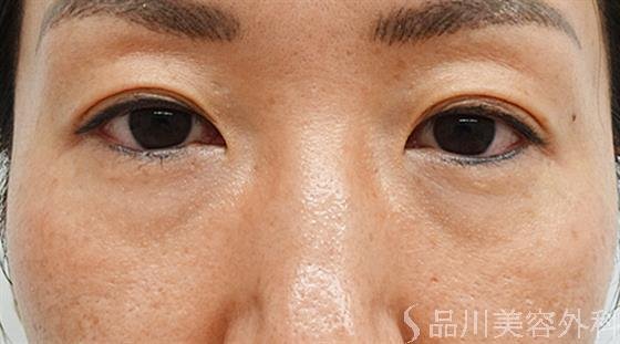 症例NO.44609のBEFORE写真
