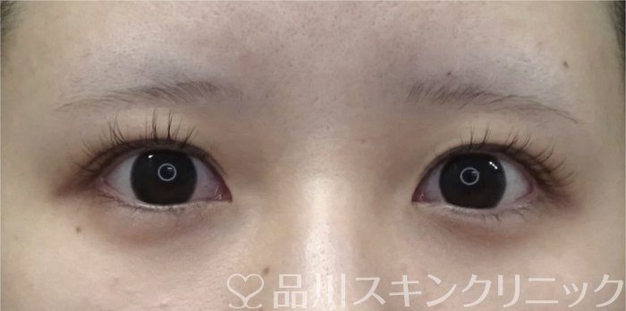 症例NO.69408のBEFORE写真