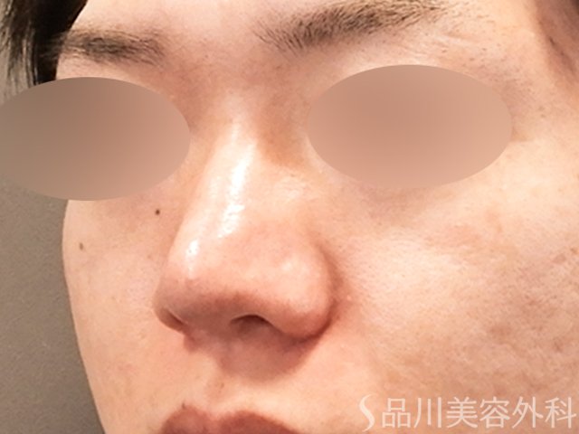 症例NO.70282のBEFORE写真