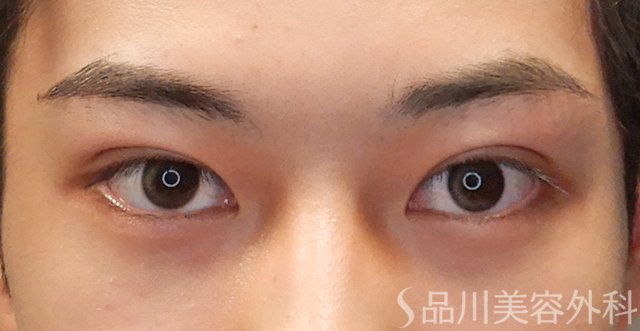 症例NO.74603のAFTER写真