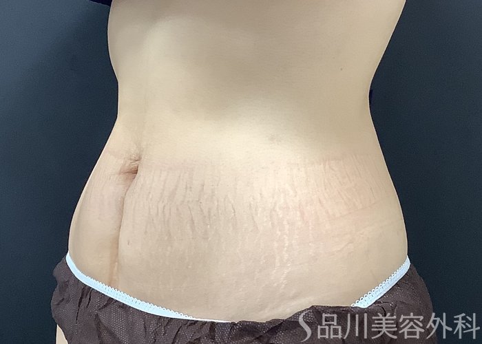 症例NO.75368のAFTER写真