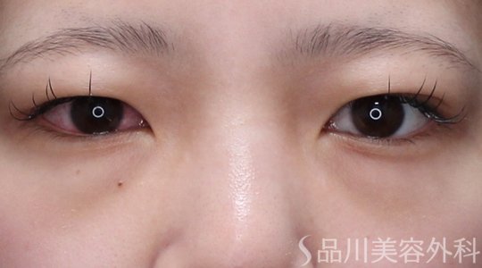 症例NO.73617のBEFORE写真