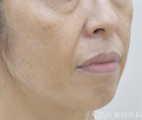 症例NO.53689のBEFORE写真