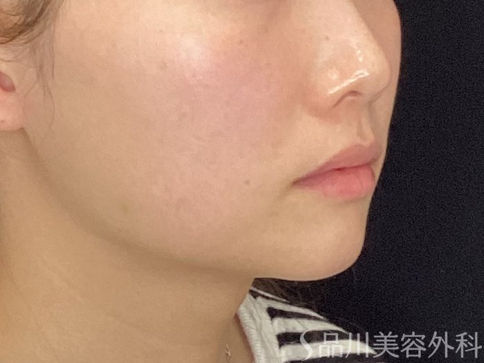 症例NO.69817のBEFORE写真