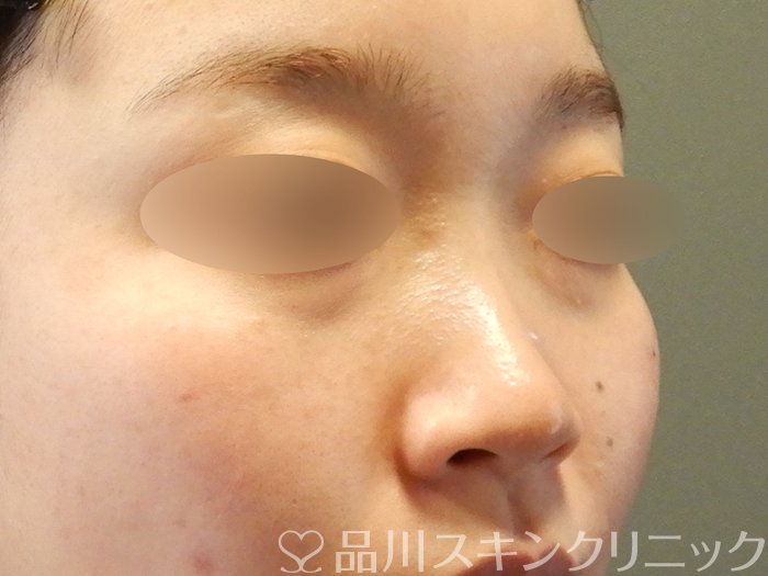 症例NO.63077のBEFORE写真