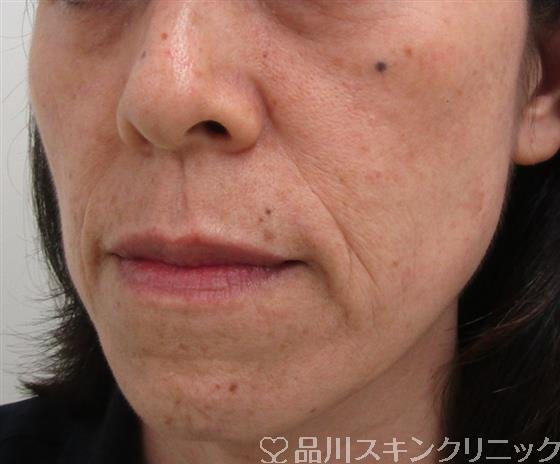 症例NO.30069のBEFORE写真