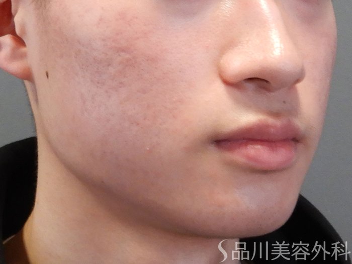 症例NO.70962のBEFORE写真