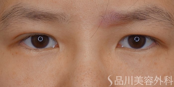 症例NO.74096のAFTER写真