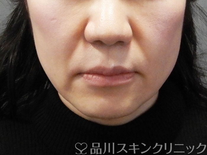 症例NO.73000のBEFORE写真