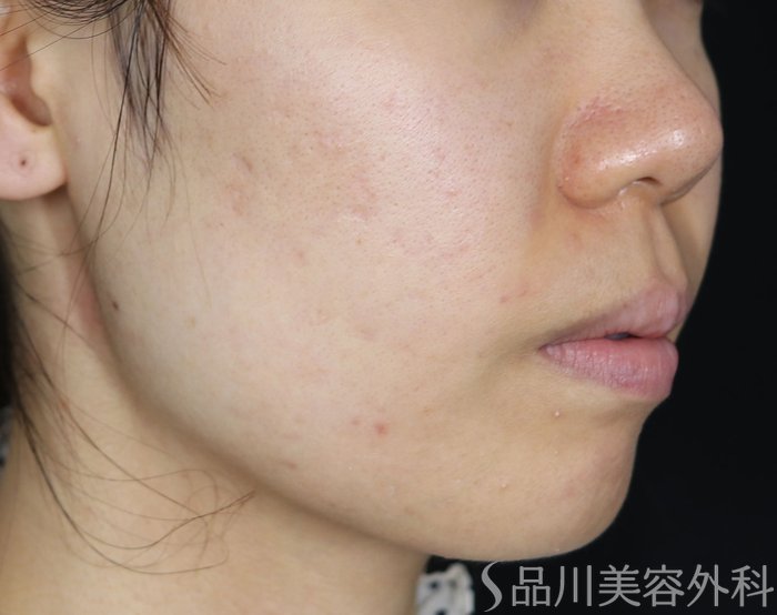 症例NO.71765のBEFORE写真