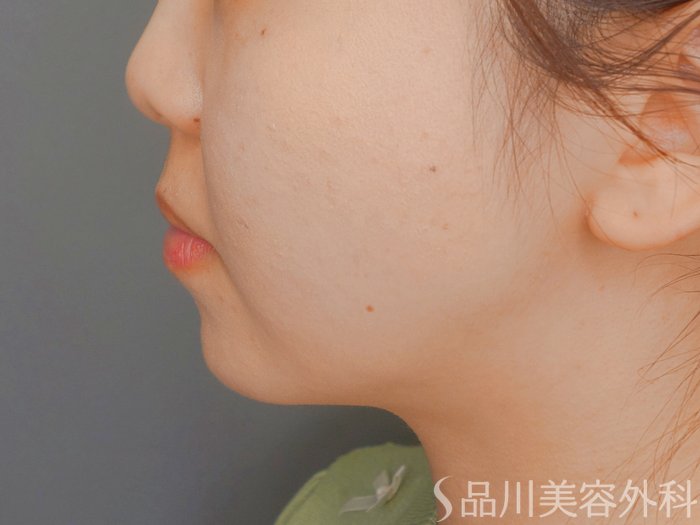 症例NO.73432のAFTER写真