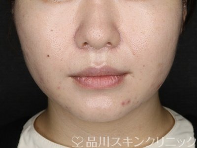 症例NO.71902のAFTER写真