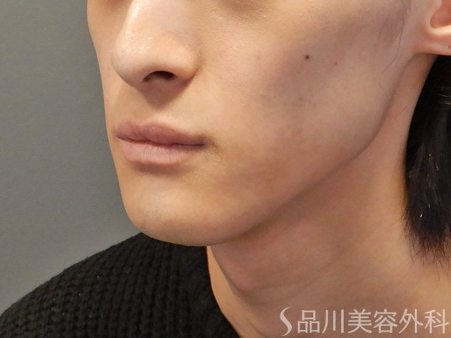 症例NO.73862のBEFORE写真